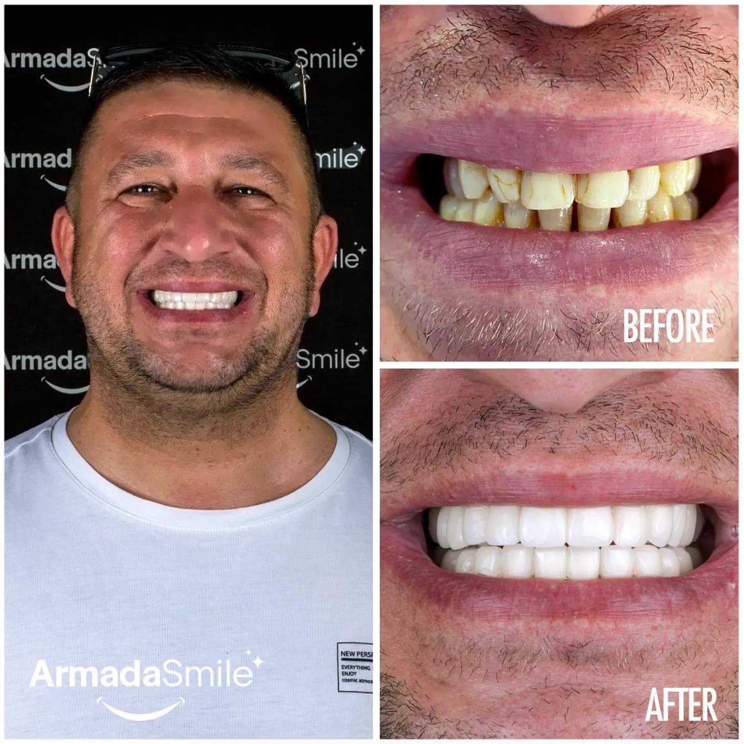 Before & after dental transformation 4
