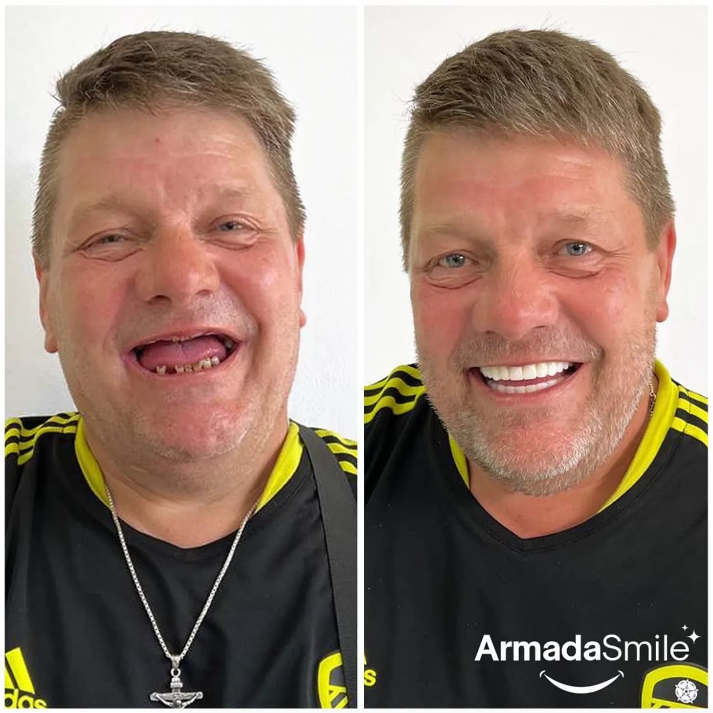 Before & after dental transformation 6